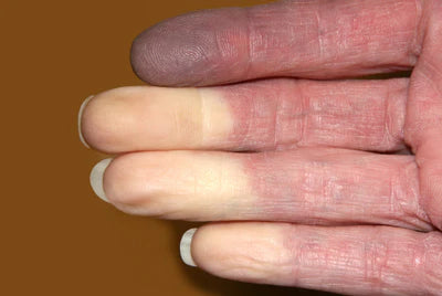 Raynaud's Disease