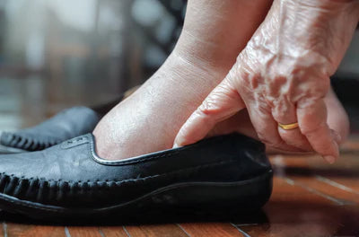 Treating Swollen Feet and Ankles